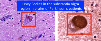 LewyBodies.150524